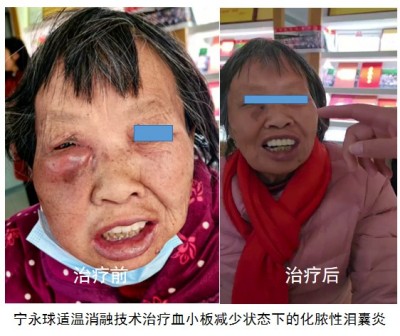 宁永球适温消融技术:中西医融合创新之路与医学革命的全球实践