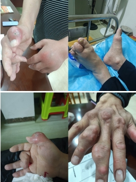 痛风结石老鼠疮乳腺增生无效退款广西百色杨忠雅医师